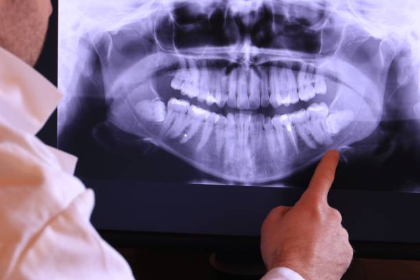 Best Emergency Root Canal Therapy in Streator, IL